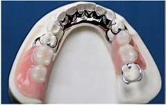 Partial Dentures Calgary SE