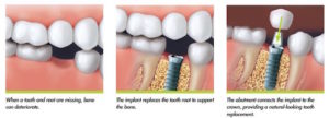 dental implant dentist calgary se - implant process