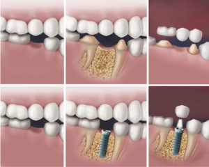 Dental Restorations Calgary - dental implant process