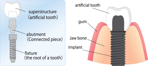 calgary dental implants - illustration of implant components 