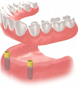 dental implant calgary se - implanted screws 