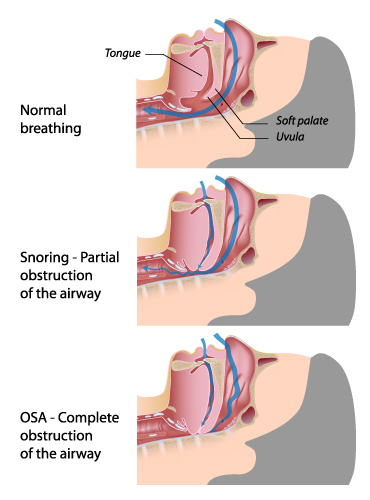 sleep-apnea