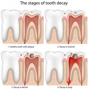 tooth-coloured-fillings-300x300